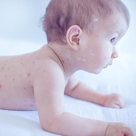 Febre alta e manchas vermelhas são os principais sintomas de sarampo - iStock