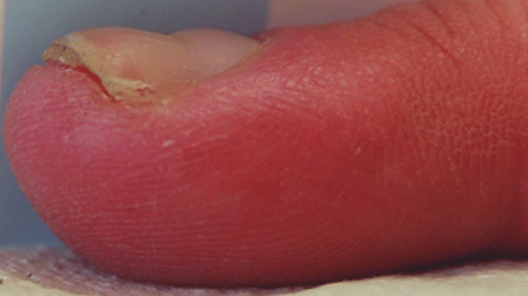 Ondulação na unha - Reprodução/Springer Science+Business Media - Reprodução/Springer Science+Business Media