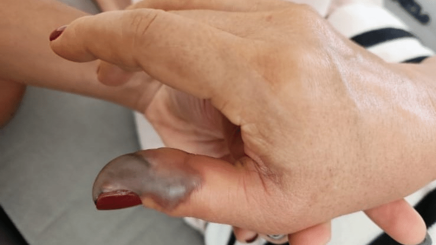 Dedo de Marise dois dias após fazer as unhas Dedo de Marise dois dias após fazer as unhas