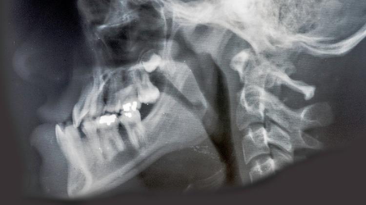 Radiografia de paciente com prognatismo - iStock - iStock