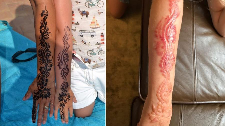 Menina de 7 anos sofreu queimadura química depois da tatuagem - Reprodução/SWNS.com