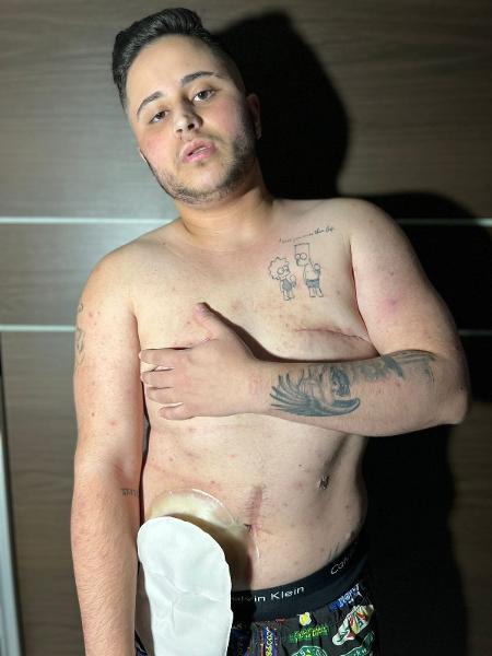 Michel Romão, 22, utiliza bolsa de ostomia após cirurgia de retirada do intestino - Arquivo pessoal