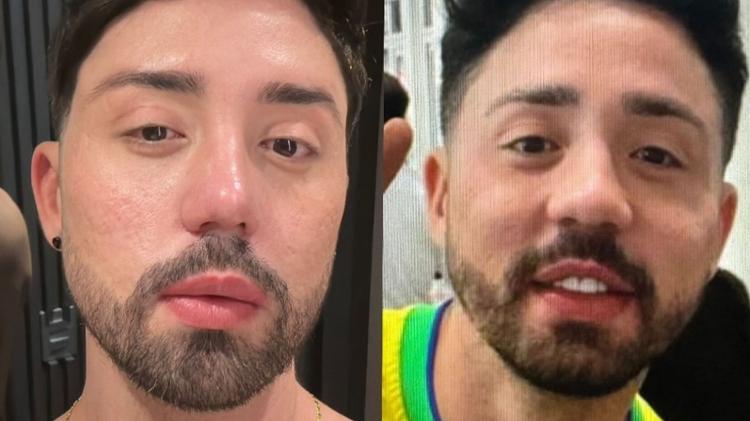 Rico Melquiades mostra antes e depois de cirurgia plástica no nariz