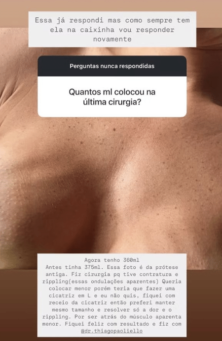 Romana explicou o que aconteceu com a prótese mamária dela Romana explicou o que aconteceu com a prótese mamária dela