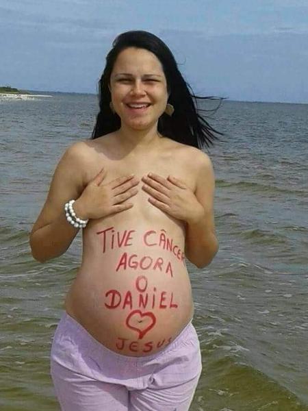 Mariana mastectomia - Arquivo pessoal - Arquivo pessoal