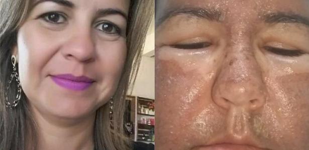 Alergia ao fenol | Ela fez peeling e perdeu um rim: 'Sentia algo comendo a minha pele'