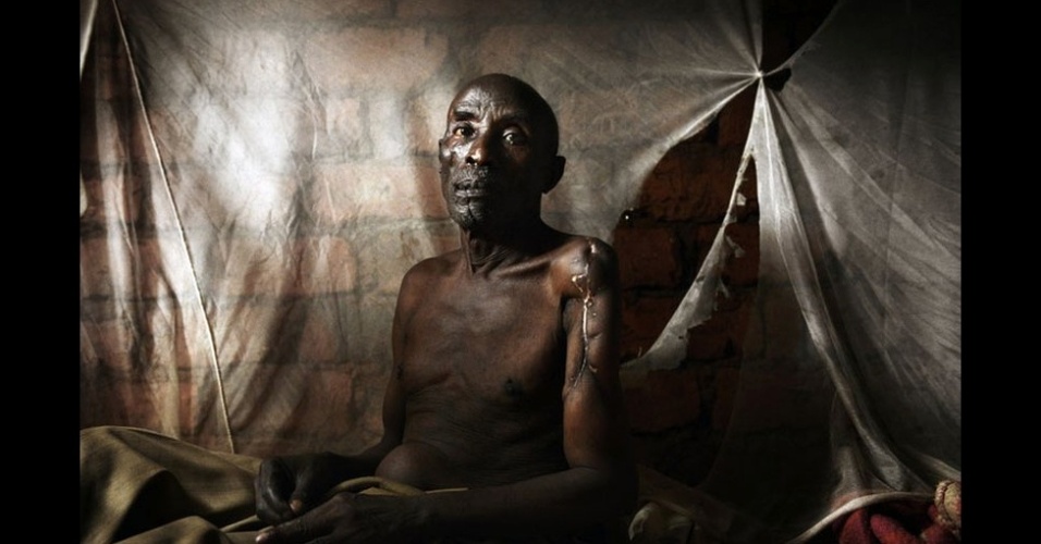 18.jun.2013 - Mathieu Nsanzugwimo retornou ao Burundi, o país mais pobre da África, em 2008. Quando voltou, soube que um de seus parentes havia tomado sua propriedade. Quando tentou reavê-la, amigos e familiares tentaram matá-lo. Seu parente passou um ano na prisão. No mesmo período, Mattieu permaneceu internado em um hospital - Chris de Bode/Pano