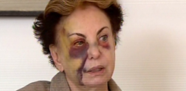  Beatriz Segall mostra hematomas no rosto em entrevista ao "Hoje em Dia"