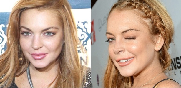 Adepta do preenchimento labial, Lindsay Lohan é frequentemente vista com os lábios disformes e pouco proporcionais às suas feições - AgNews e Getty Images
