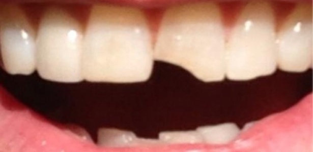 Jim Carrey posta foto com dente quebrado, em referência ao seu personagem em  "Debi & Lóide" - Reprodução