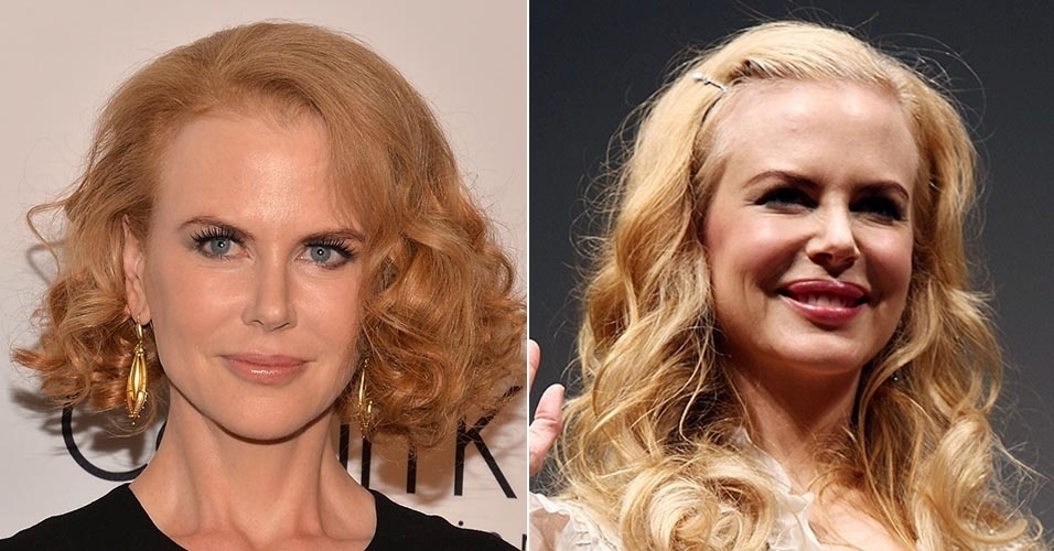 Nicole Kidman também já se entregou a um preenchimento labial que deixou seu sorriso estranho