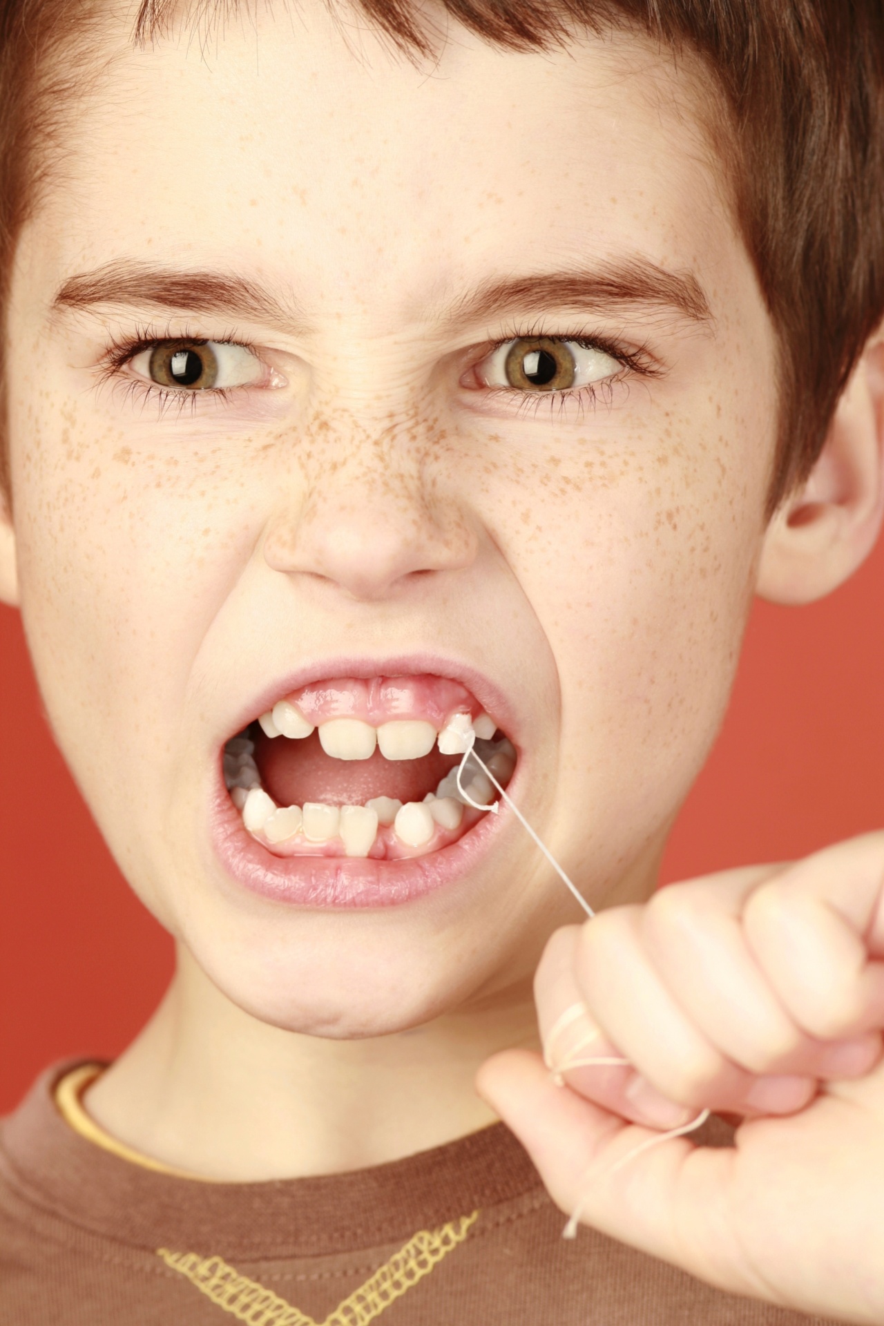 Se o dente de leite está mole, quase caindo, os pais podem arrancá-lo em casa, com a ajuda de um lenço ou então amarrando um fio e puxá-lo? Embora pareça um procedimento simples e fácil de ser realizado, na opinião de Imparato, não é recomendado fazê-lo porque o dente pode estar um pouco preso à gengiva por um pedacinho de raiz. "Nesse caso, ao tentar arrancá-lo, os pais podem machucar a criança" - Getty Images