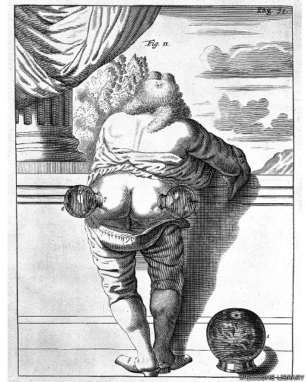 Imagem cedida pela Wellcome Library, a maior biblioteca da história médica do mundo, mostra "ventosaterapia", um tratamento ancestral por meio do qual vasos quentes são colocados sobre a pele - Wellcome Libray