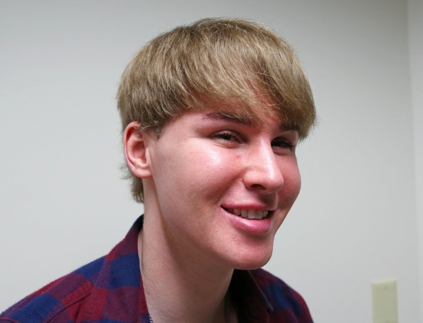 4.fev.2013 - Toby Sheldon, de 33 anos, fez aplicação de botox para ficar parecido com seu ídolo, o cantor Justin Bieber