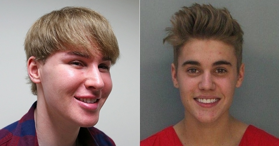 4.fev.2013 - Toby Sheldon, de 33 anos, fez aplicação de botox para ficar parecido com seu ídolo, o cantor Justin Bieber. E aí, ficou parecido?