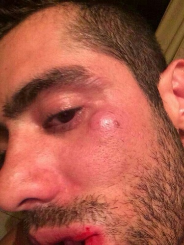 5.set.2014 - Ex-BBB Yuri mosta hematomas no rosto depois de brigar com a namorada Angela Sousa e ser acusado de agressão