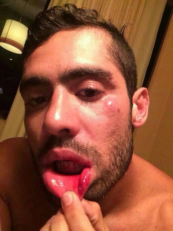 5.set.2014 - Ex-BBB Yuri mostra hematomas na boca depois de briga com a namorada Angela Sousa, em Maceio