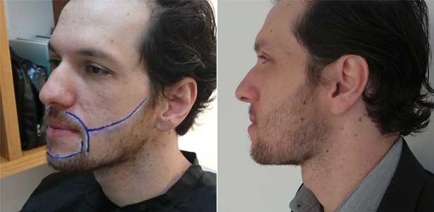 Antes e depois: o analista de comércio exterior Vagner Henrique da Rocha mostra o resultado do procedimento de implante de pelos no rosto - Divulgação/Acervo Pessoal