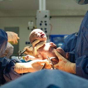 A taxa de lesões para os bebês em posição invertida que nasceram de cesárea é menor - Getty Images