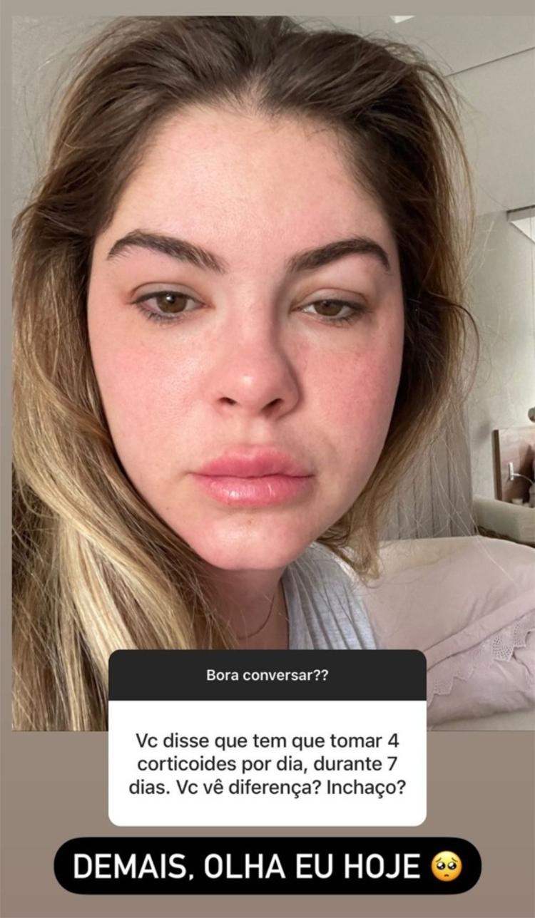 Bárbara Evans mostra rosto inchado por conta de tratamento para engravidar - Reprodução/Instagram - Reprodução/Instagram