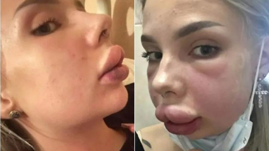 Kristina Vishnivetskaya mostra que os lábios e bochechas ficaram inchadas - Reprodução/Instagram
