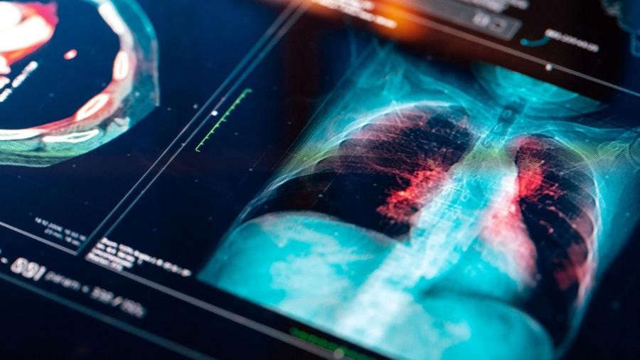 Estudo com inteligência artificial focou em casos de câncer de pulmão - da-kuk/iStock