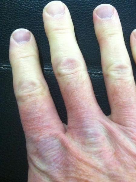 Unhas de um paciente com doença de Raynaud - WaltFletcher/Reprodução - WaltFletcher/Reprodução