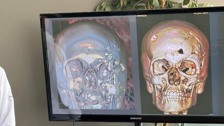 Comparação antes e depois da colocação das próteses