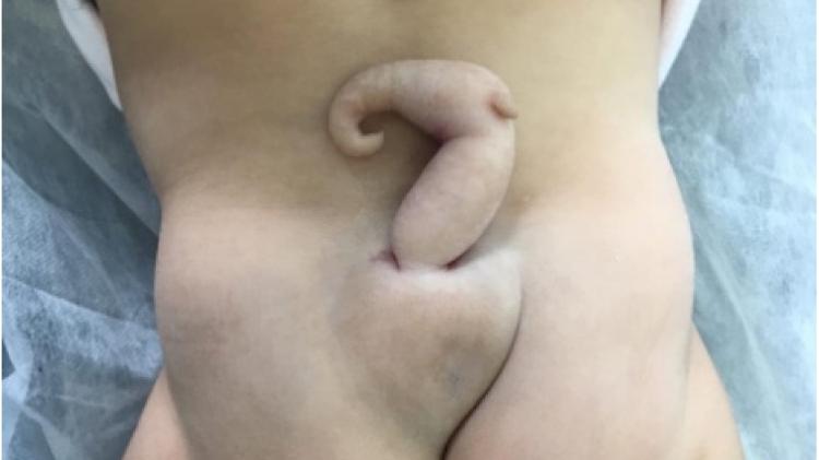 Bebê brasileira nasceu com cauda de 6 centímetros 