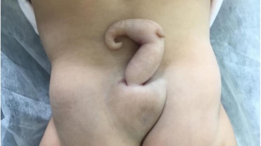 Bebê brasileira nasceu com cauda de 6 centímetros  - Divulgação/Journal of Pediatric Surgery Case Reports