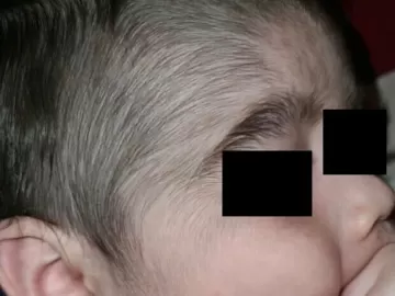 Minoxidil: produto anticalvície usado pelo pai fez crescer pelos em bebês