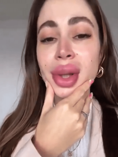 Carol Narizinho ficou com os lábios inchados após reverter o preenchimento - Reprodução/Instagram