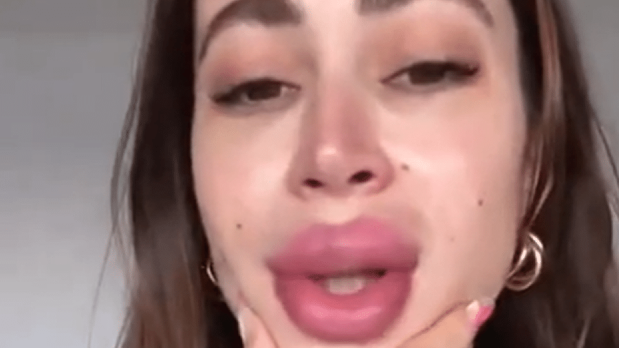 Carol Narizinho exibiu os lábios muito inchados nas redes sociais - Reprodução/Instagram