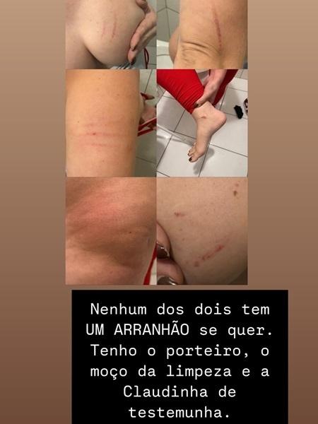 Vanessa Cunha mostra lesões no corpo após agressão da ex-sogra Vanessa Cunha mostra lesões no corpo após agressão da ex-sogra