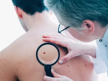 Câncer de pele: quais os tipos mais comuns e suas características?