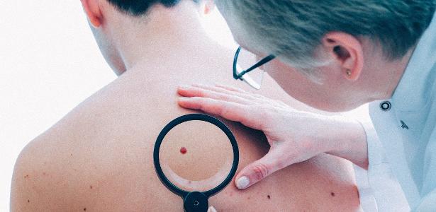 O tipo de câncer mais frequente no país é o de pele não melanoma - iStock