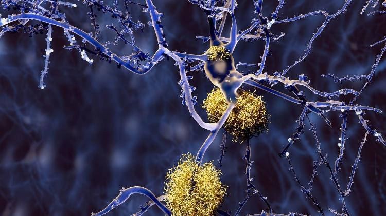 O acúmulo de proteínas beta-amiloide e tau no cérebro prejudica a comunicação entre os neurônios 