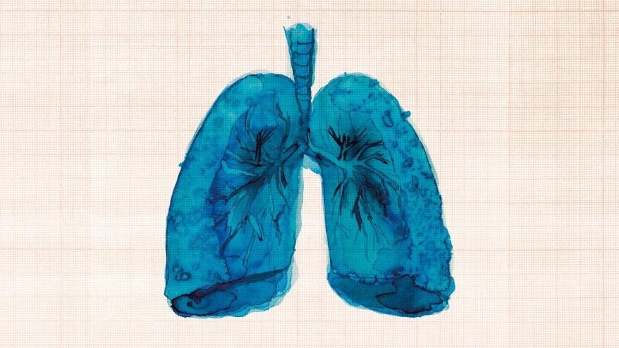 Infecção causada pelo Sars-CoV-2 nas células pulmonares pode levar à formação de fibroses - Kika Carvalho