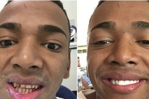 Nego do Borel sempre sonhou com o sorriso "iluminado" - Divulgação - Divulgação