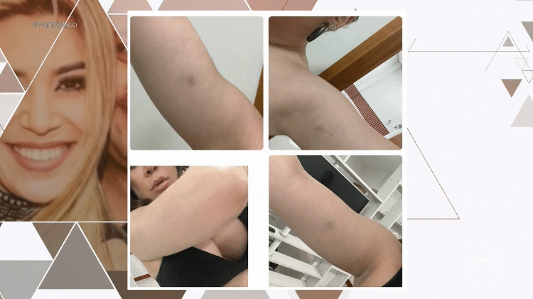 Fantástico mostra fotos de hematomas em processo de Naiara Azevedo contra ex-marido