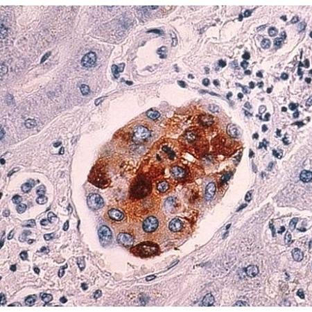 Cientistas descobrem que alguns tipos de câncer, como o de pele, possuem células com características de células-tronco, capazes de dar origem a outras células - National Cancer Institute / Wikimedia Commons