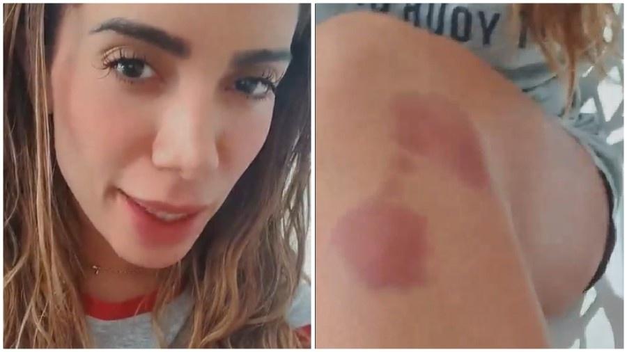 Anitta mostra machucado após coreografia - Instagram