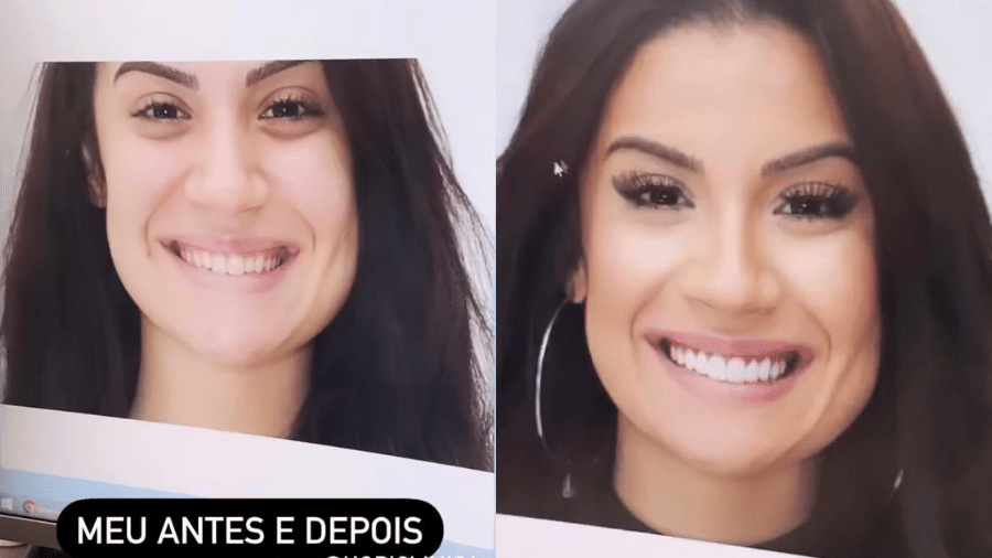 Bianca Andrade mostra antes e depois de seu sorriso - Reprodução/Instagram/@bianca
