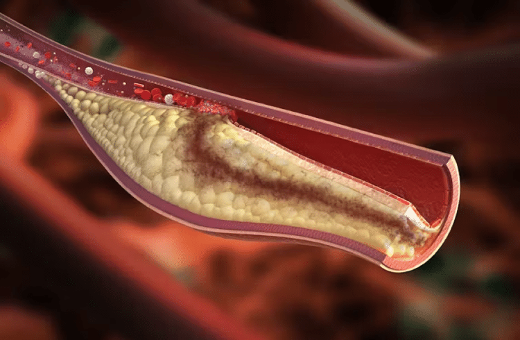 Os microplásticos foram encontrados em amostras de placa extraídas da artéria carótida dos pacientes