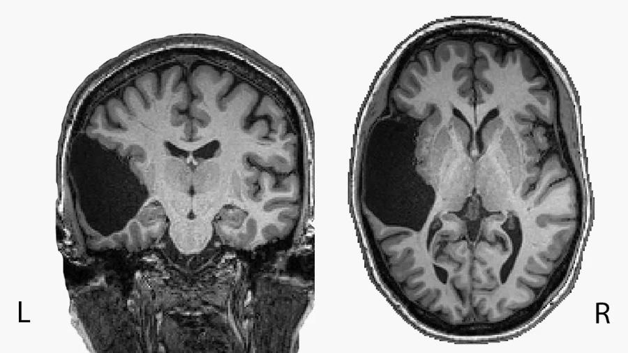 Pesquisadores avaliaram ressonâncias do cérebro de EG - Departamento de Cérebro e Ciências Cognitivas do MIT