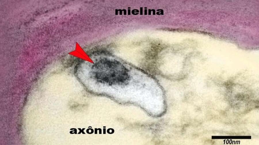 A imagem mostra um axônio de um neurônio do cérebro de uma criança com síndrome inflamatória multissistêmica pediátrica (SIM-P). A seta aponta o vírus SARS-CoV-2 em uma vesícula no citoplasma do axônio - Elia Caldini / BBC News Brasil