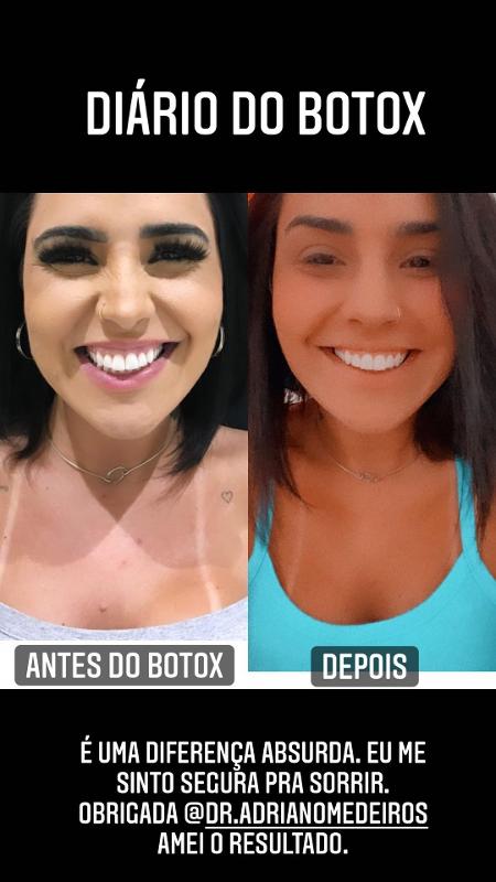 Botox Antes e Depois - Como ter um bom resultado