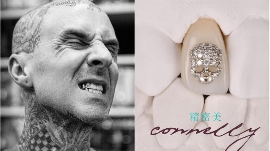 Travis Barker colocou diamante de 8 mil dólares no dente - Reprodução/Instagram @connellydds