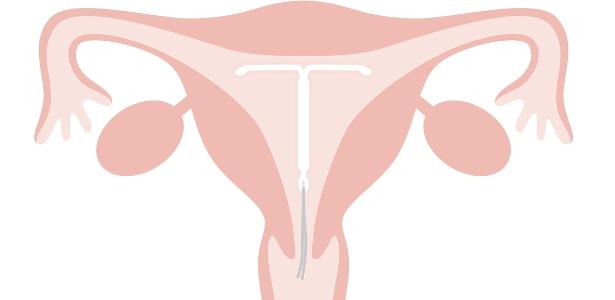 Just to avoid the baby?  no!  The IUD helps treat some health problems