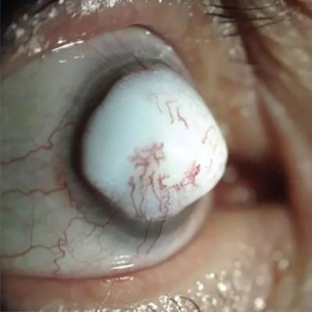A queloide da córnea é extremamente rara - JAMA Ophthalmology